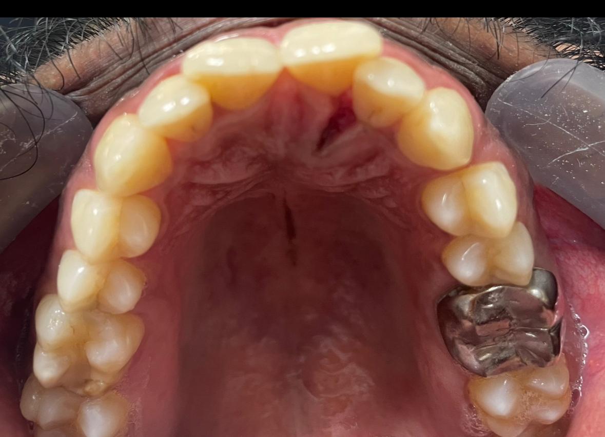 Aligner case, stage one