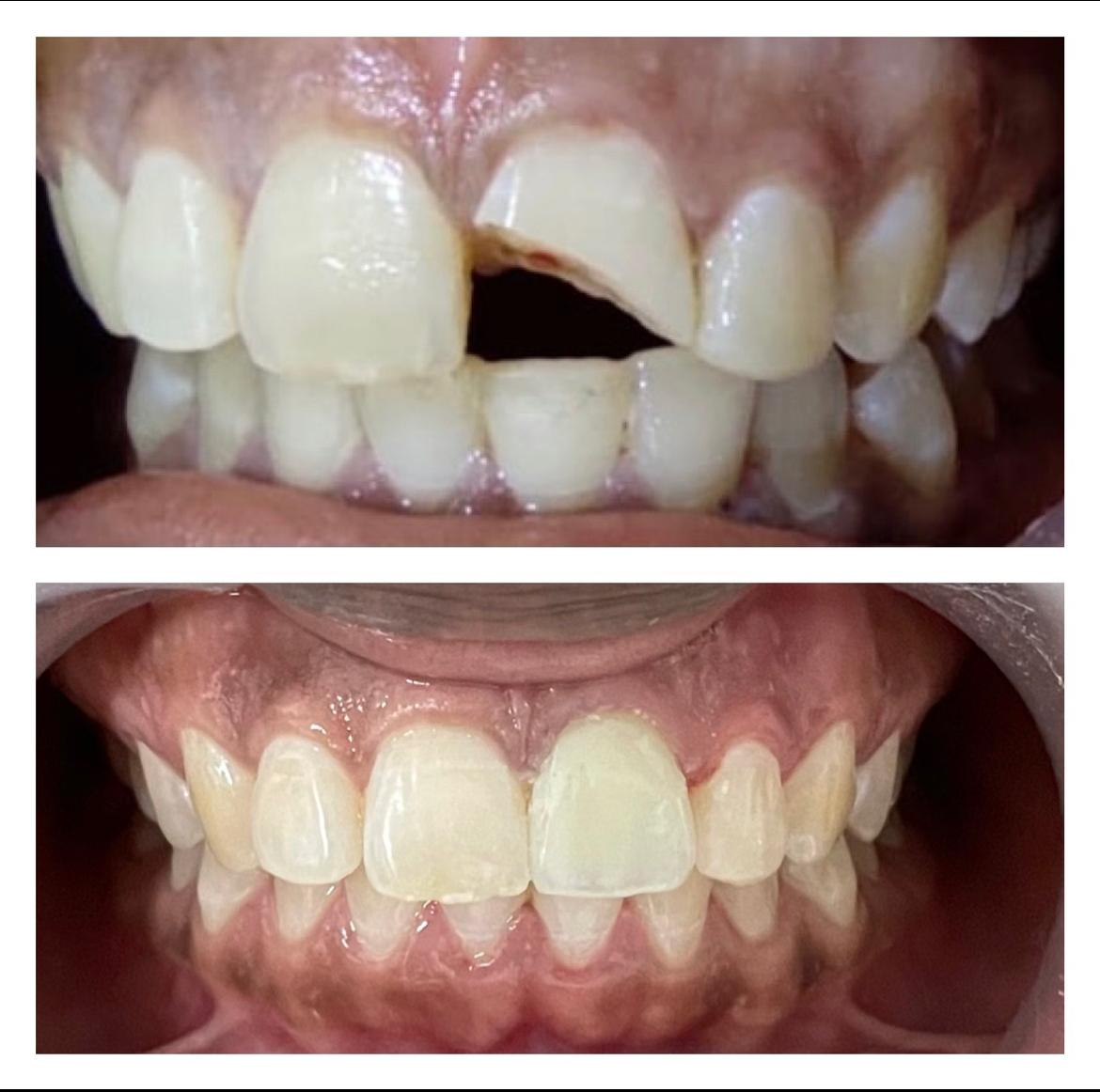 Fractured front tooth, before and after restoration